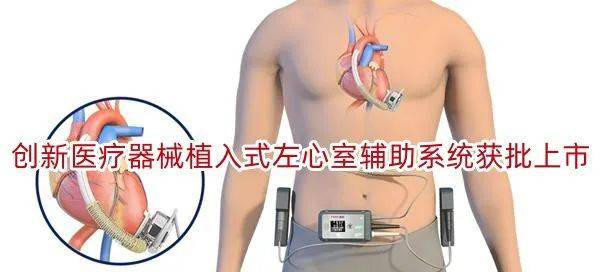 植入式左心室辅助系统.jpg