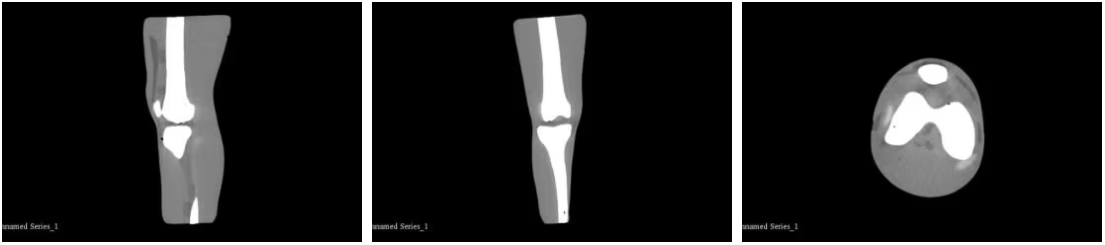 成人膝关节（仅骨骼）6.png